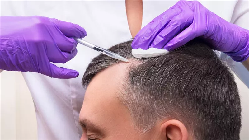 هل تدوم زراعة الشعر مدى الحياة؟.. نصائح مهمة لتجنب الصلع