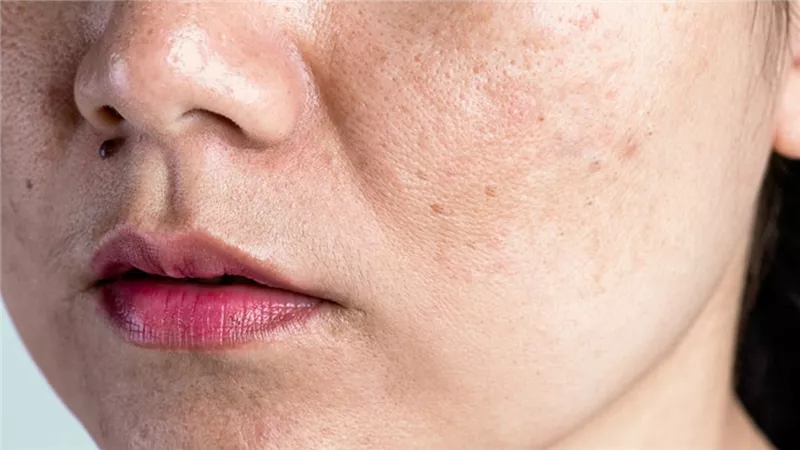 كيف تساعد قشور البطاطس في تقليل التصبغات؟.. إليكِ طريقة مضمونة