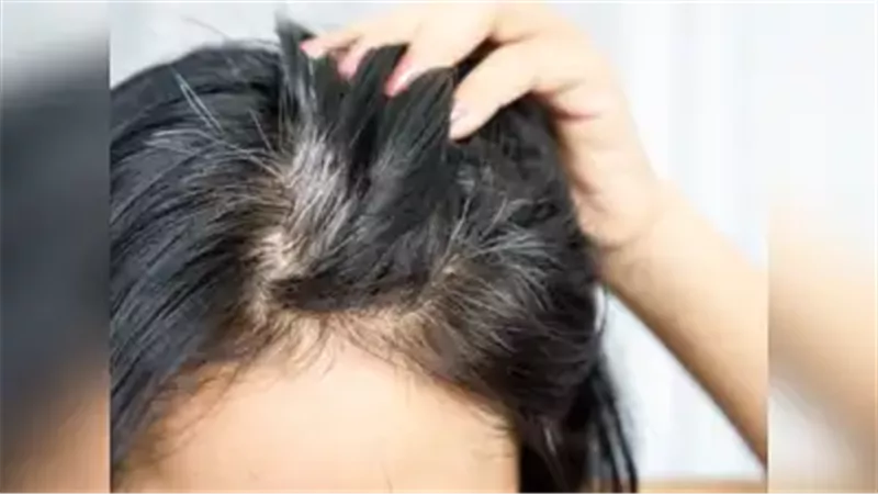 5 نصائح لوقف الشيب المبكر والحفاظ على شعر كثيف وصحي