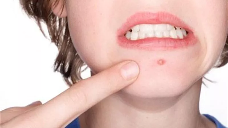 تحذيرات من انتقال الهربس للأطفال.. 5 خطوات للوقاية من العدوى