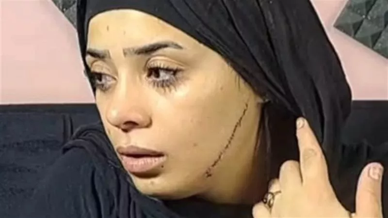 41 غرزة .. تطور جديد في قضية المتهمة بتشويه وجه عروس طليقها بمصر القديمة 