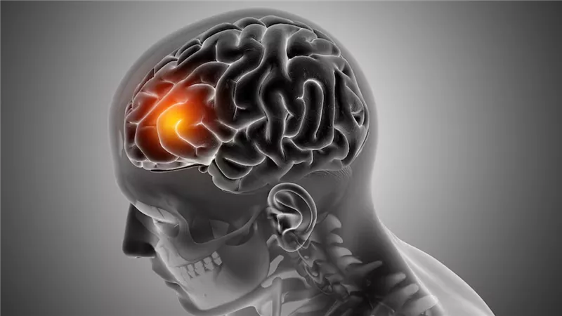 الساعة الذهبية لإنقاذ الحياة.. ما أعراض السكتة الدماغية وكيف يُمكن علاجها سريعًا؟