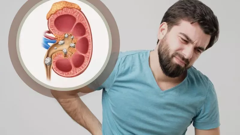 حصوات الكلى.. خطر متزايد يمكن الوقاية منه