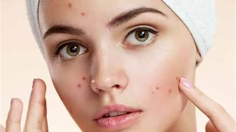  5 نصائح ذهبية لبشرة نضرة في موسم الخريف.. والتخلص من حب الشباب 