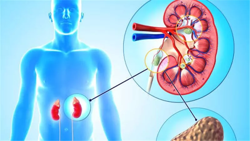  ما الأسباب الحقيقية لحصوات الكلى وسبل العلاج والوقاية؟