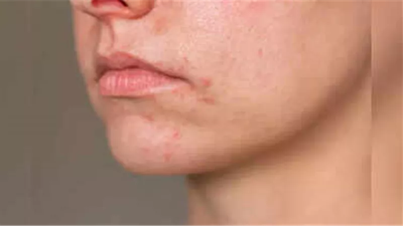 وداعًا لالتهاب الجلد حول الفم.. أفضل العلاجات المنزلية البسيطة