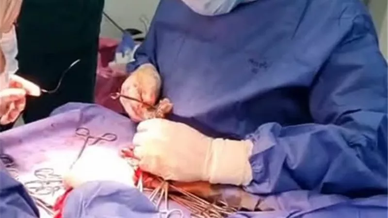 نجاح جراحة دقيقة لإصلاح أوتار يد مريض بمستشفى العدوة المركزي