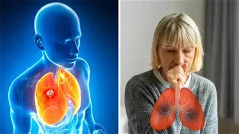 سرطان الرئة لا يقتصر على المدخنين.. مخاطر صامتة تهدد غير المدخنين أيضًا