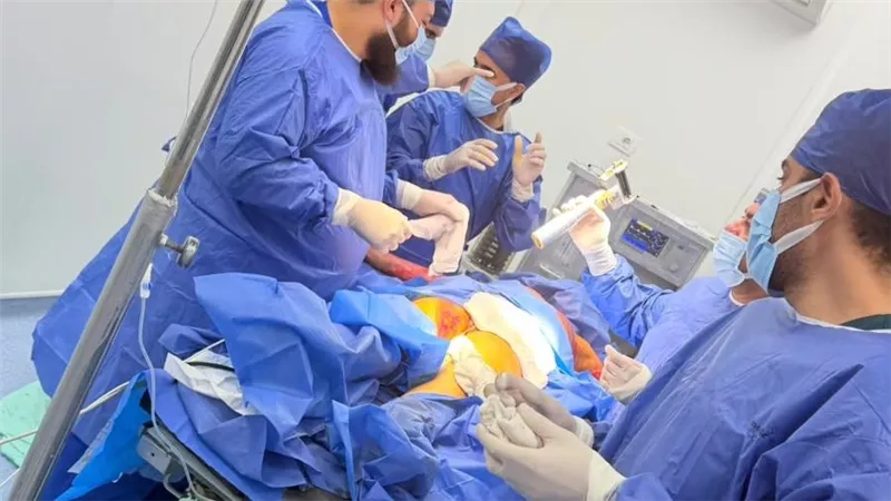 إجراء أول جراحة ترقيع جلدي لطفل مصاب بحروق تجاوزت 30 بالمئة بالدقهلية 