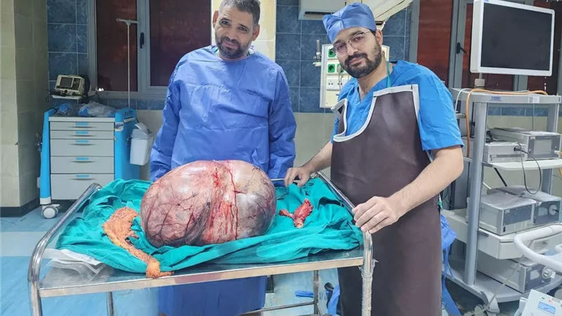 بمهارة فريق طبي مصري.. استئصال ورم مبيضي عملاق يزن 24 كيلو بالمنيا