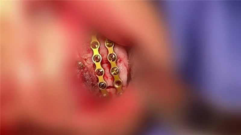 بـ 3 شرائح و20 مسمارًا.. نجاح جراحة دقيقة لتثبيت فك طفل في المنيا